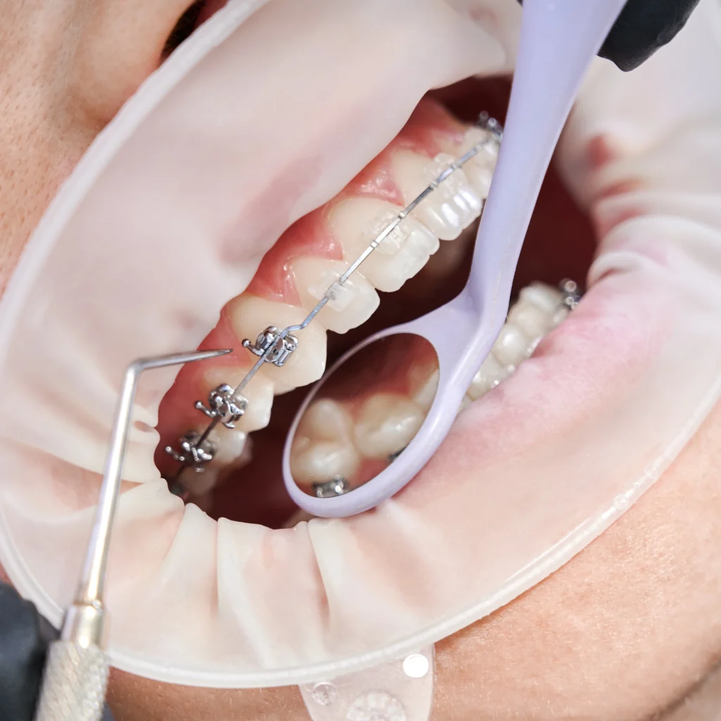 dentist-attaching-metal-braces-to-patient-teeth-2025-01-16-23-52-46-utc